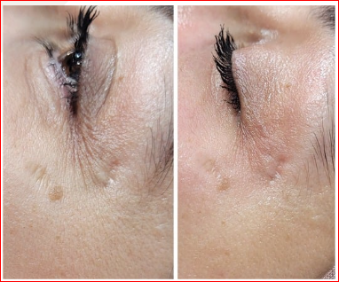 Exemple avant / après : Contour des yeux